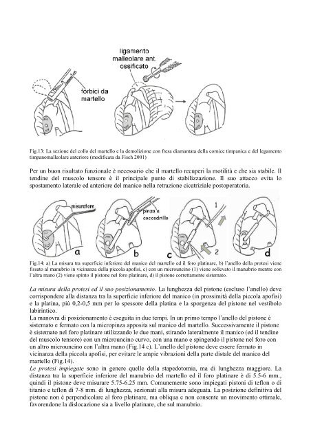 La chirurgia di revisione di stapedoplastica. - Orlpisa.It