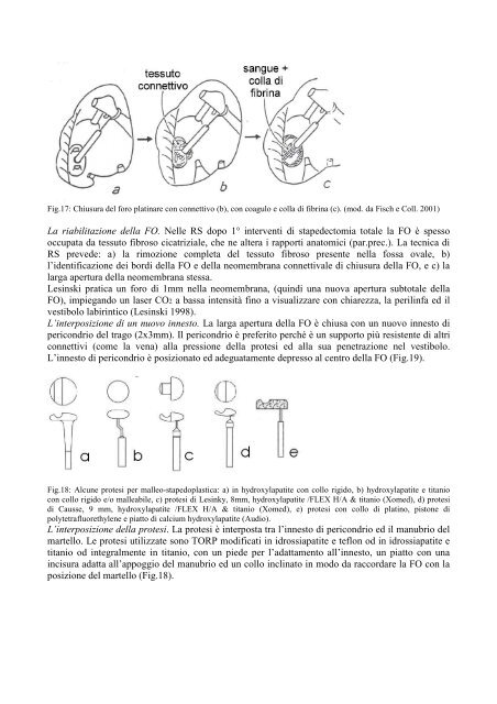 La chirurgia di revisione di stapedoplastica. - Orlpisa.It