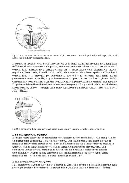 La chirurgia di revisione di stapedoplastica. - Orlpisa.It