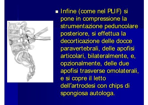 L'artrodesi intersomatica mediante approccio trans - Pierpaolo Mura