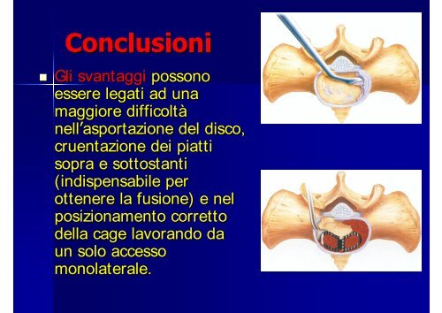 L'artrodesi intersomatica mediante approccio trans - Pierpaolo Mura