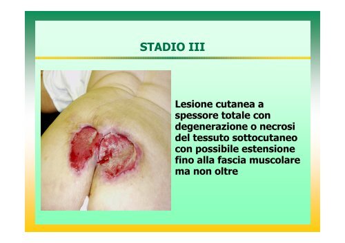 l'infermiere nella prevenzione e nel trattamento delle lesioni da ...