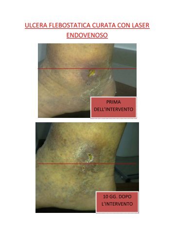 ULCERA FLEBOSTATICA CURATA CON LASER ENDOVENOSO