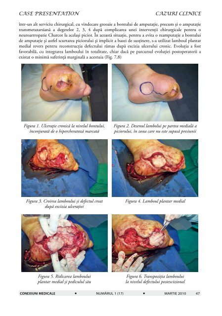 reconstrucţia în piciorul diabetic utilizând lamboul insular plantar ...