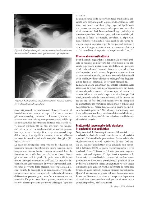 Le fratture della clavicola - Fondazione Internazionale Menarini