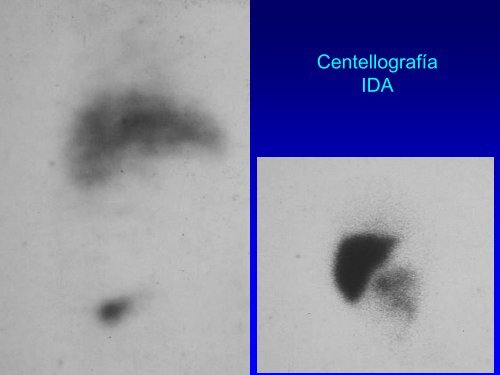 diagnostico diferencial de las colestasis neonatales - aaeeh