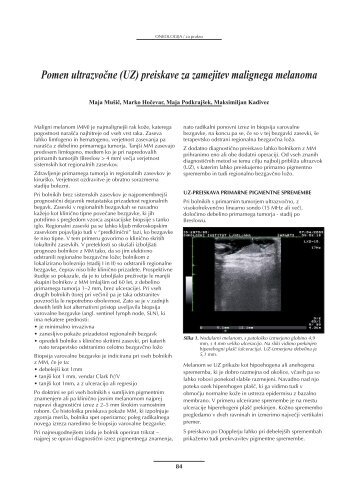 Pomen ultrazvočne (UZ) preiskave za zamejitev malignega melanoma