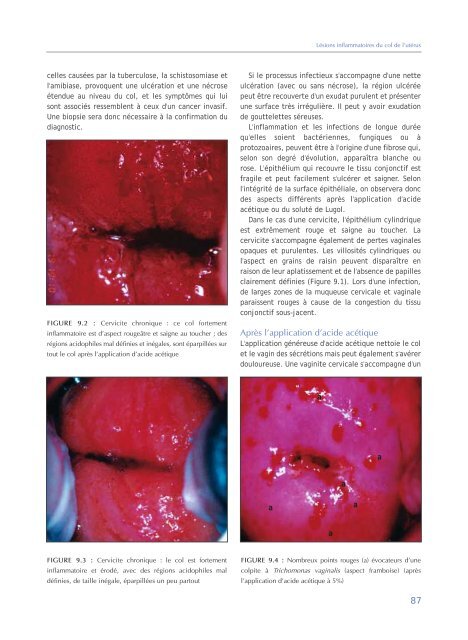 Colposcopie et Traitement des Néoplasies Cervicales Intraépithéliales