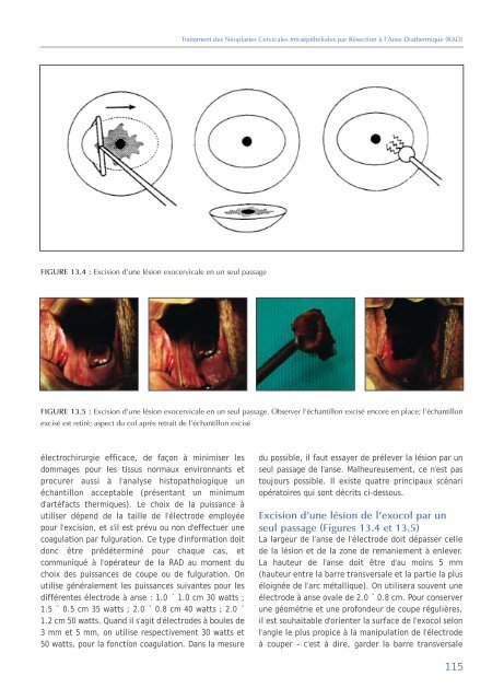 Colposcopie et Traitement des Néoplasies Cervicales Intraépithéliales