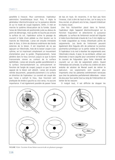 Colposcopie et Traitement des Néoplasies Cervicales Intraépithéliales