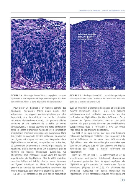 Colposcopie et Traitement des Néoplasies Cervicales Intraépithéliales