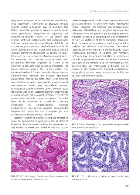 Colposcopie et Traitement des Néoplasies Cervicales Intraépithéliales
