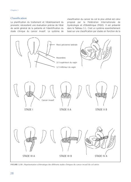 Colposcopie et Traitement des Néoplasies Cervicales Intraépithéliales