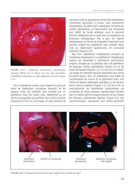 Colposcopie et Traitement des Néoplasies Cervicales Intraépithéliales