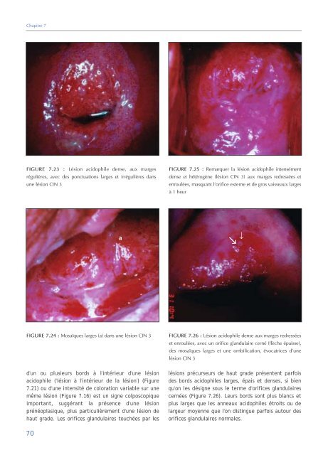 Colposcopie et Traitement des Néoplasies Cervicales Intraépithéliales