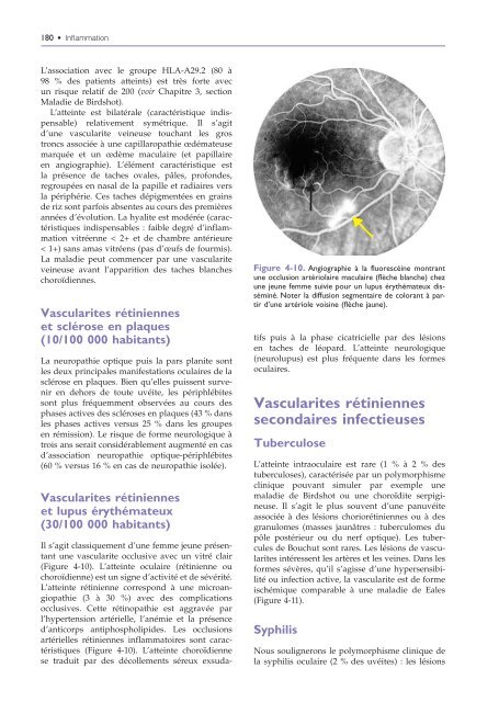 Extrait du volume 4 : Inflammation de la rétine - Lavoisier