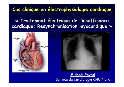 Cas clinique en électrophysiologie cardiaque « Traitement ...