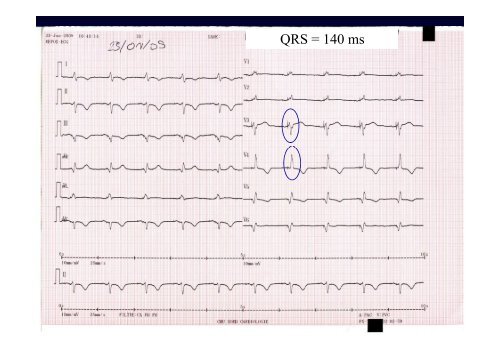 Cas clinique en électrophysiologie cardiaque « Traitement ...