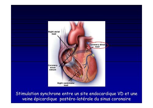 Cas clinique en électrophysiologie cardiaque « Traitement ...