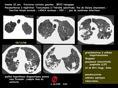 D CC thorax papillomatose laryngée adulte - RADIOLOGIE BRABOIS