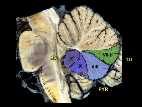 LE CERVELET Anatomie et Imagerie