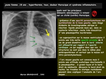 LM CC thorax tumeur carcinoïde bronchique typique - RADIOLOGIE ...