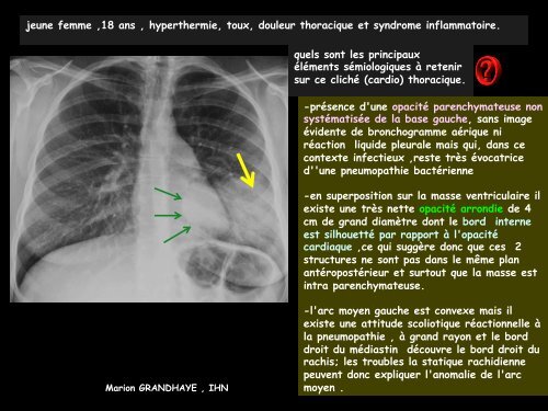 LM CC thorax tumeur carcinoïde bronchique typique - RADIOLOGIE ...