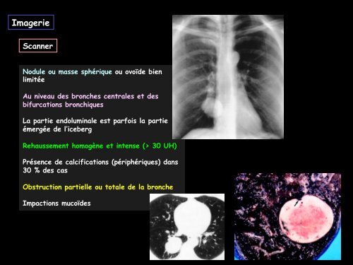LM CC thorax tumeur carcinoïde bronchique typique - RADIOLOGIE ...