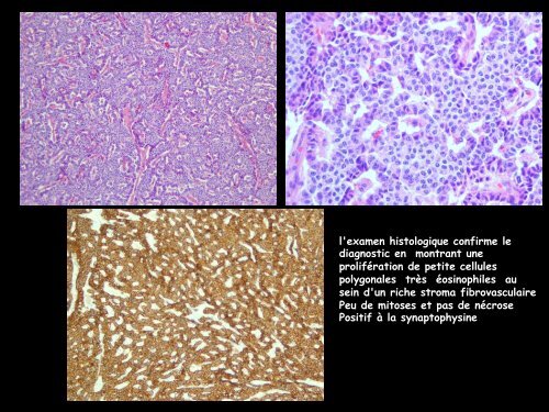 LM CC thorax tumeur carcinoïde bronchique typique - RADIOLOGIE ...