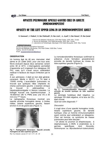 OPACITE PULMONAIRE APICALE GAUCHE CHEZ UN ADULTE ...