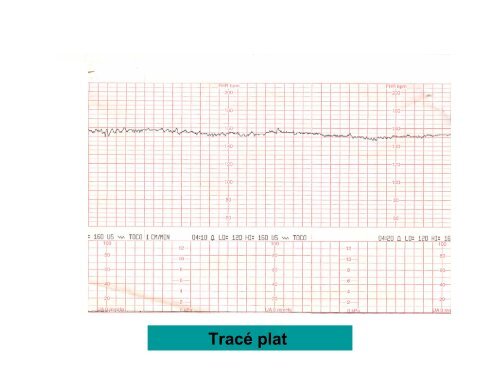 Analyse Visuelle du Rythme Cardiaque Fœtal RCF (pendant le travail)