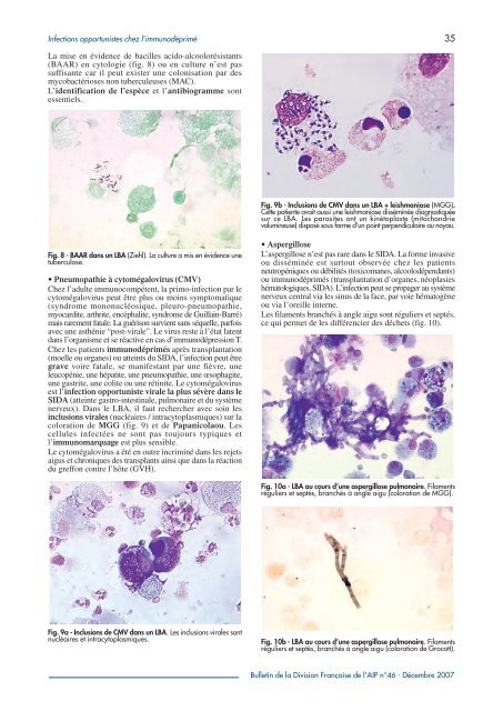 Infections opportunistes chez l'immunodéprimé - AFIAP