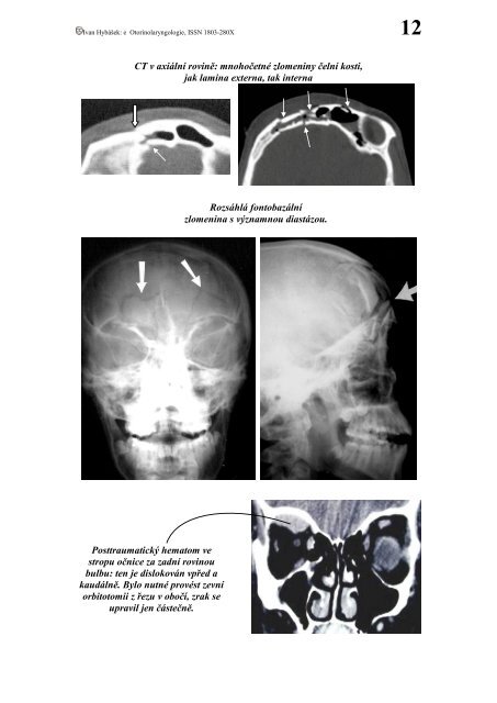 12 orl traumatologie (8,2 mb)