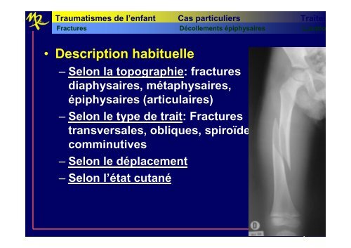 Traumatologie de l'enfant - CHU de Rouen