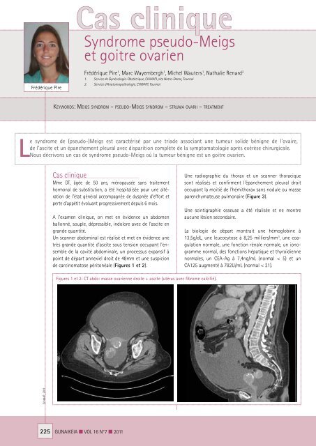 Syndrome pseudo-Meigs et goitre ovarien