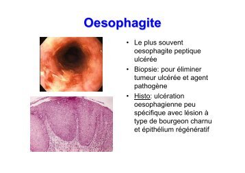 Pathologie inflammatoire oesophagite gastrite colite