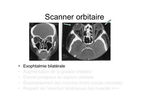 Tumeurs inflammatoires orbitaires - Pierre Kaminsky