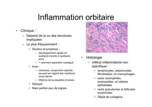 Tumeurs inflammatoires orbitaires - Pierre Kaminsky