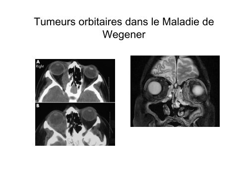 Tumeurs inflammatoires orbitaires - Pierre Kaminsky