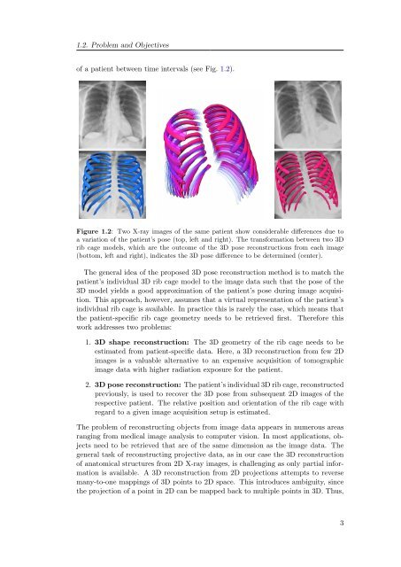 3D Reconstruction of the Human Rib Cage from 2D Projection ... - ZIB