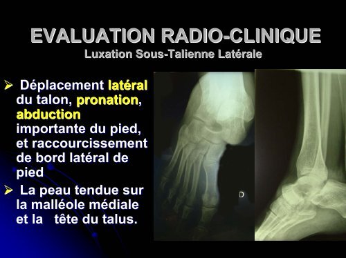 la luxation sous-talienne post-traumatique - Société d'orthopédie ...