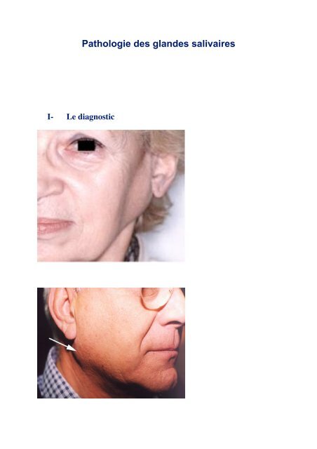 Pathologie des glandes salivaires