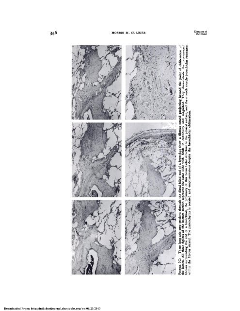 Obliterative Bronchitis and Bronchiolitis with Bronchiectasis*