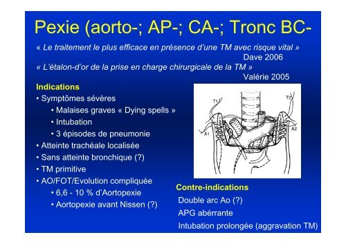 Prise en charge de la trachéo et bronchomalacie