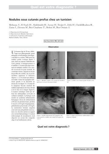 Nodules sous cutanés profus chez un tunisien