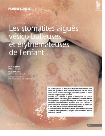 Les stomatites aiguës vésico-bulleuses et érythémateuses de l'enfant