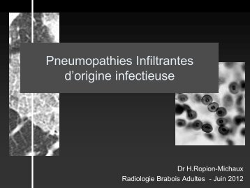 pneumopathies infiltrantes-infectieuses - RADIOLOGIE BRABOIS