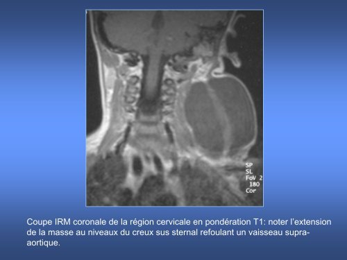 imagerie des masses kystiques cervicales de l'enfant - smorl