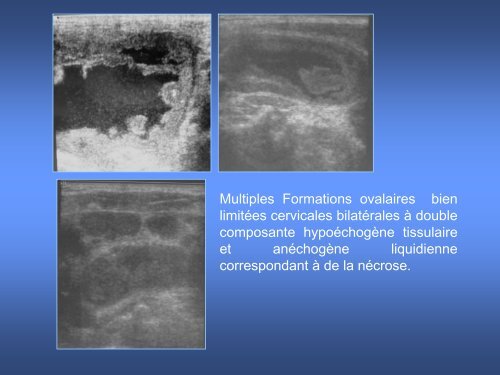 imagerie des masses kystiques cervicales de l'enfant - smorl