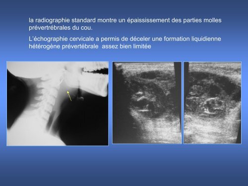 imagerie des masses kystiques cervicales de l'enfant - smorl